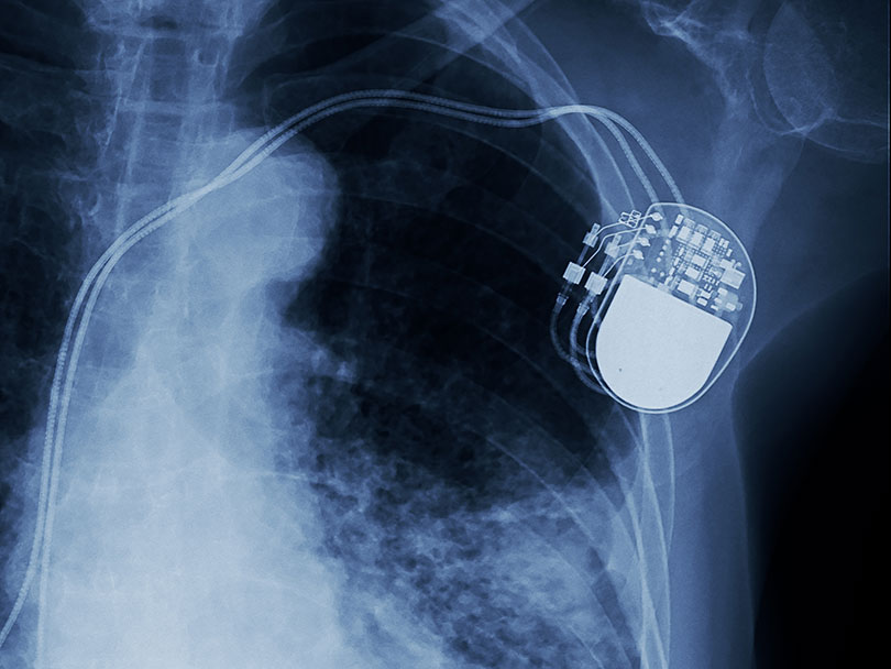 Implanted medical device